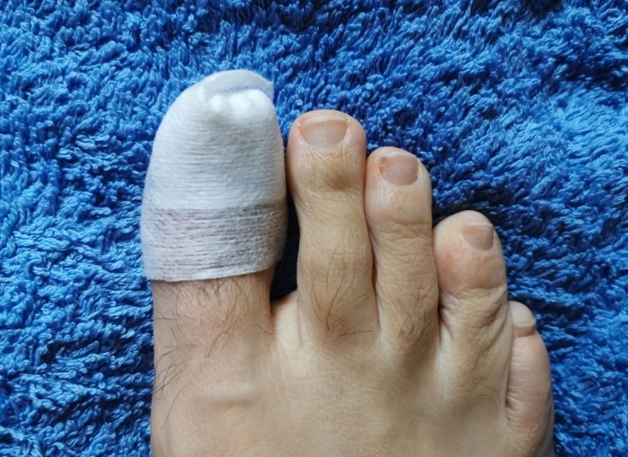 Symptoms Of A Toe Injury